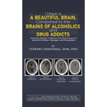 I Have a Beautiful Brain, Compared to the Brains of Alcoholics and Drug Addicts - Hardcover