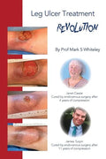 Leg Ulcer Treatment Revolution - Paperback