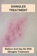 Shingles Treatment: Relieve And Say No With Shingles Treatment: Shingles On Face Treatment - Paperback