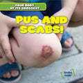 Pus and Scabs! - Library Binding