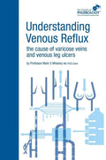 Understanding Venous Reflux the Cause of Varicose Veins and Venous Leg Ulcers: Varicose veins and venous leg ulcers - Paperback