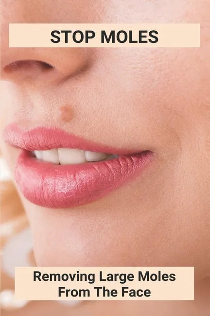 Stop Moles: Removing Large Moles From The Face: Surefire Way To Get Rid Of Moles - Paperback
